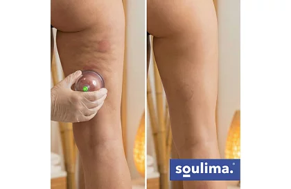 Sada čínských baněk na baňkování bez ohně – 12 kusů